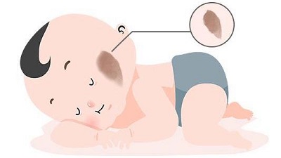 胎记患者秋季要如何科学运动？