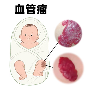 血管瘤是什么原因？该怎么治？