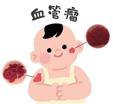 血管瘤严重吗？什么情况下需要治疗？