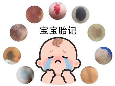 宝宝胎记受哪些影响？南京胎记医院排名
