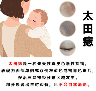 南京胎记医生哪里好点？南京太田痣患者可以晒太阳吗？